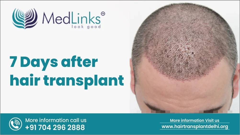 7 Days After Hair Transplant: What To Expect?