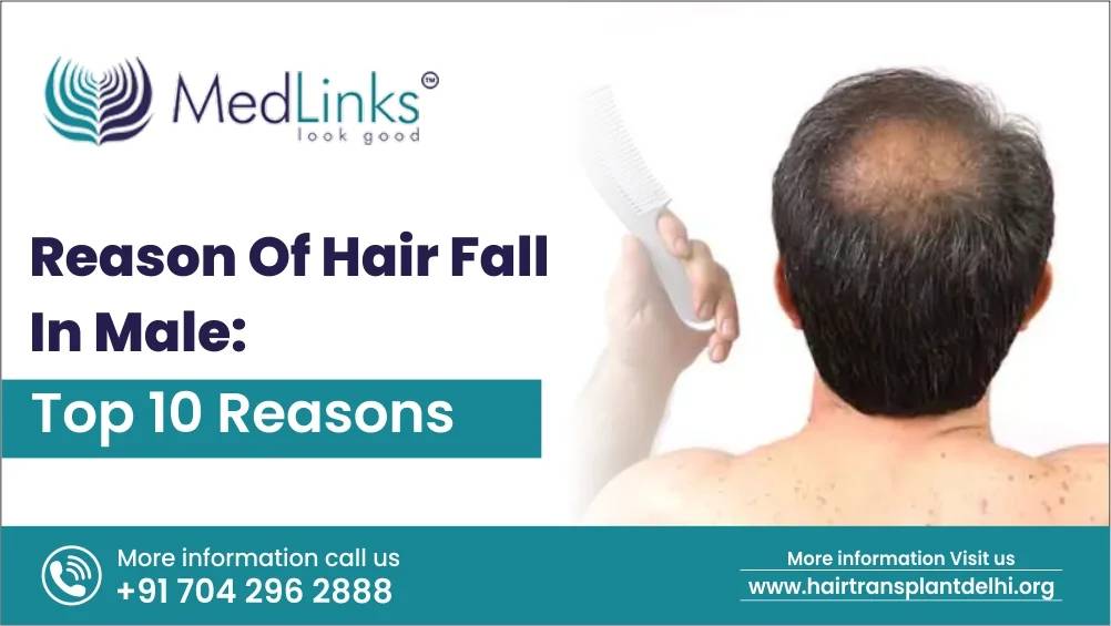 Reason for Hair Fall in Males: Top 10 Reasons