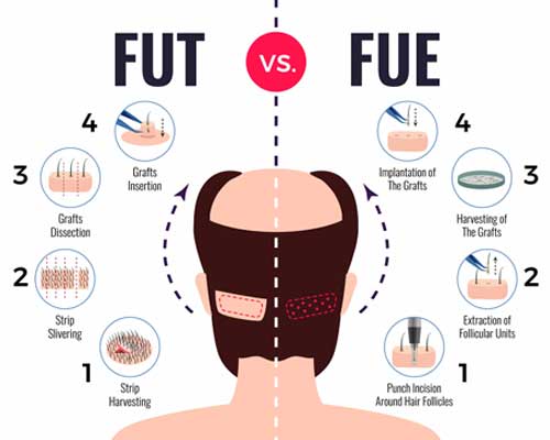 hair transplant lifespan