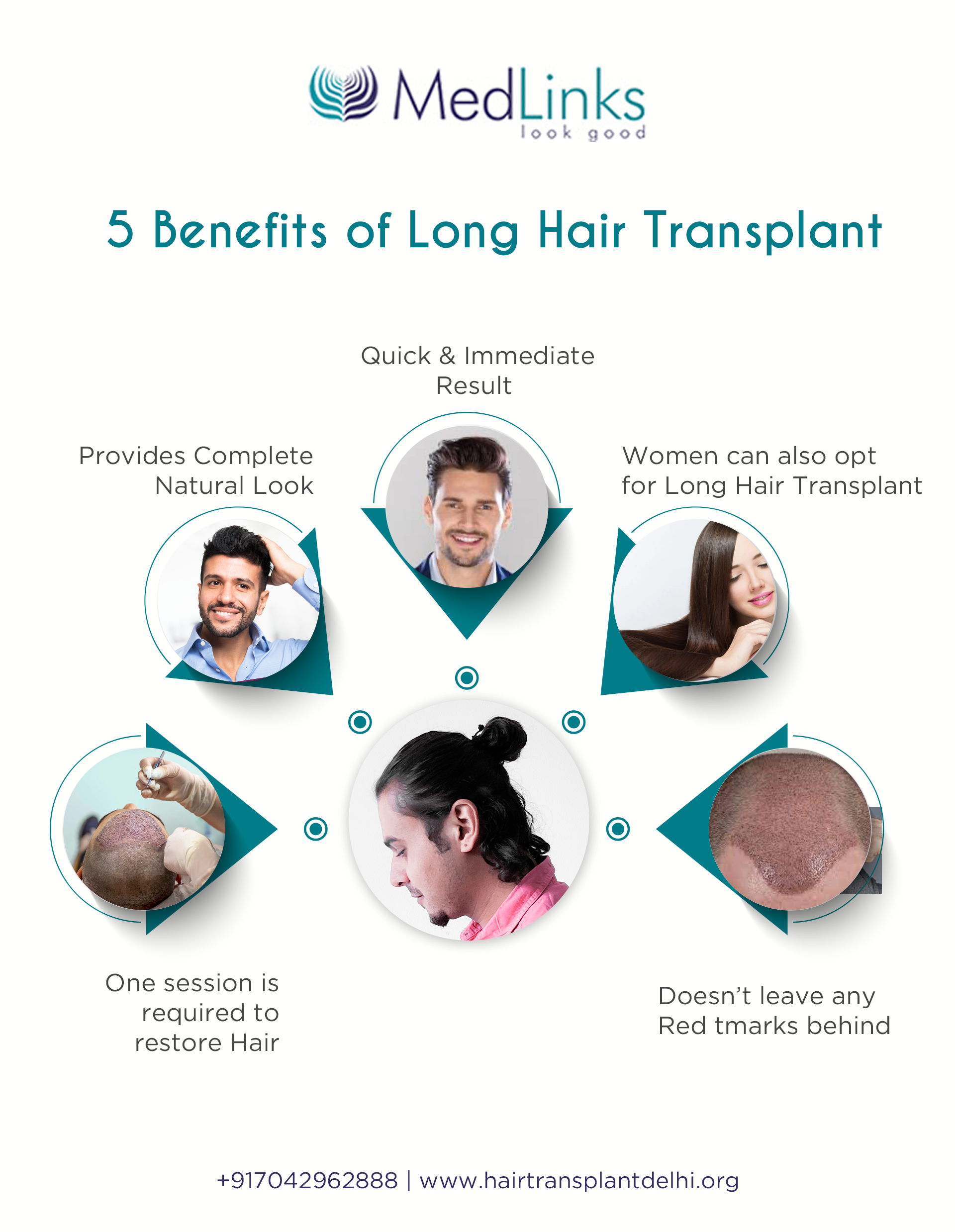 Long hair transplant