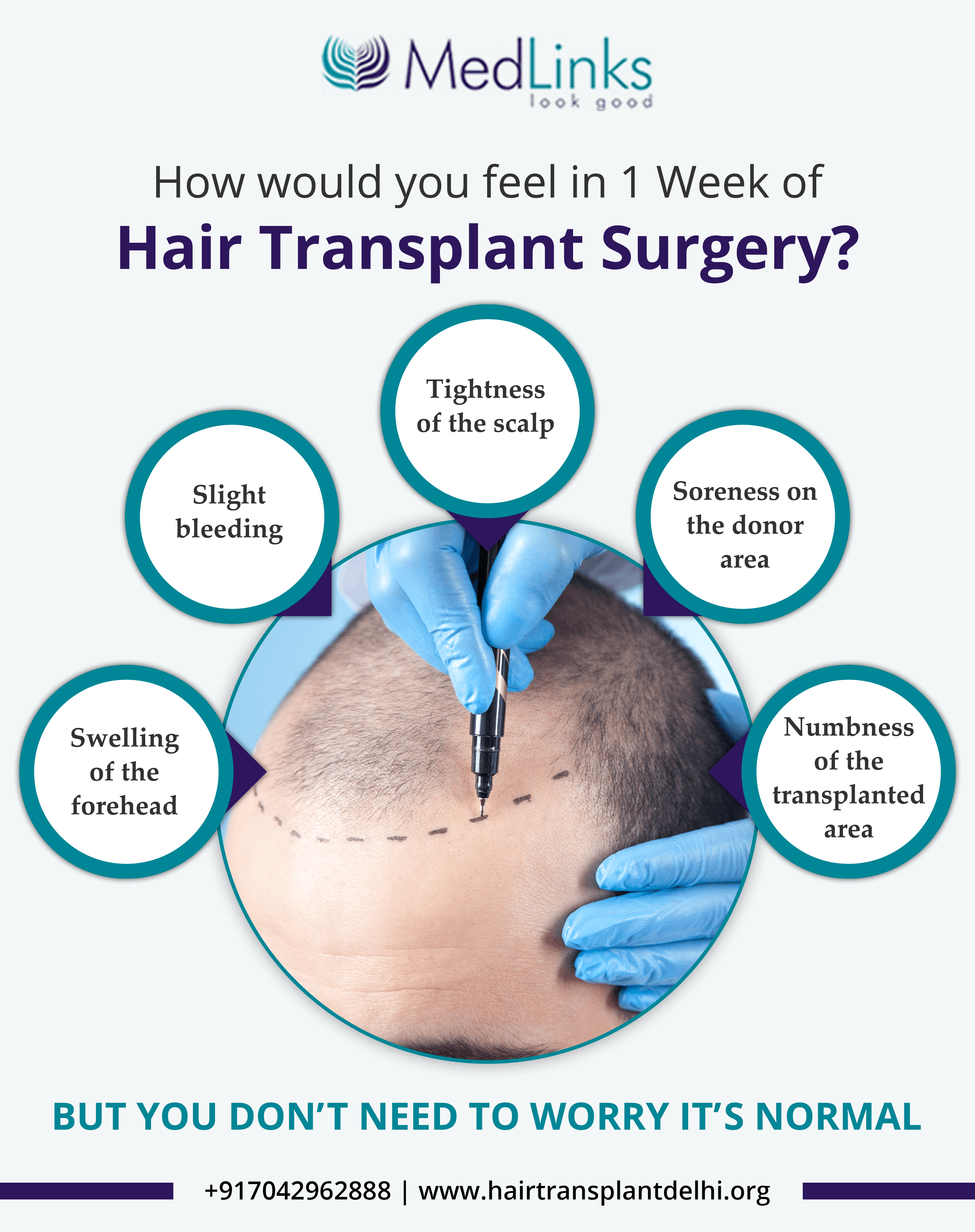 hair transplant surgery