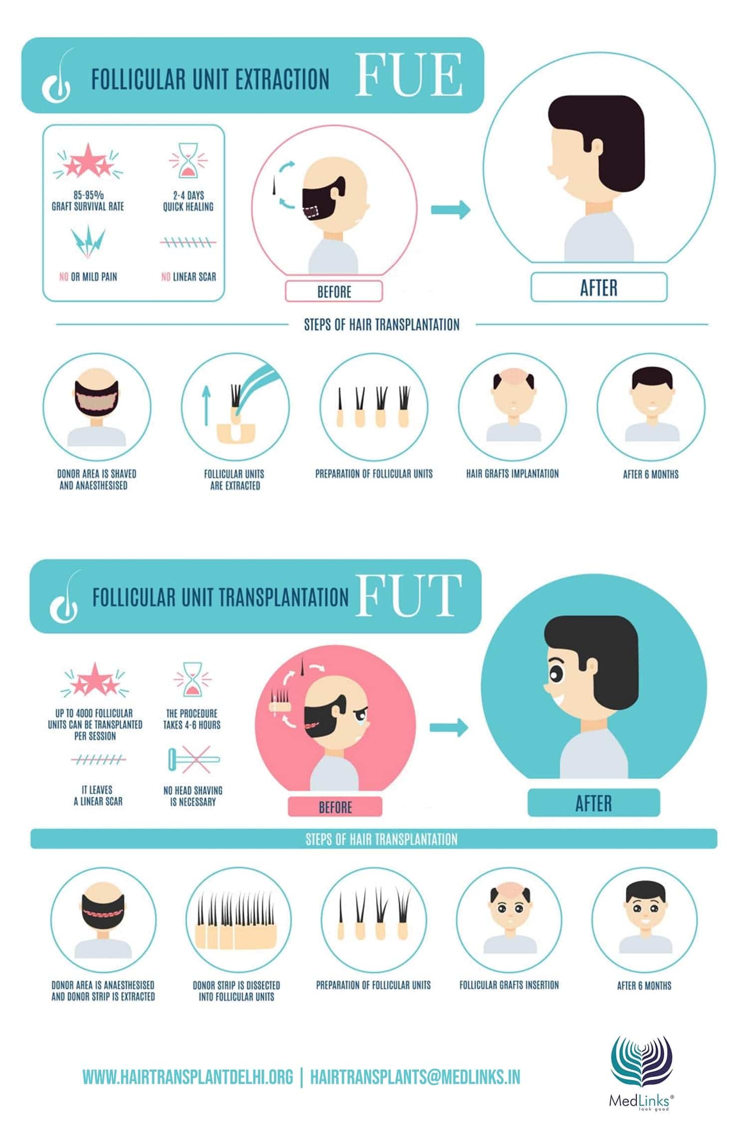 hair transplant lifespan