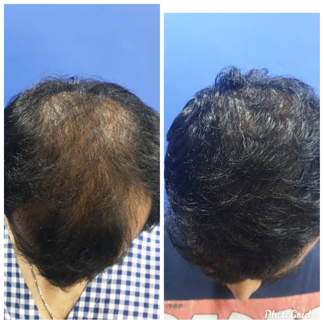 best hair transplant clinic in India