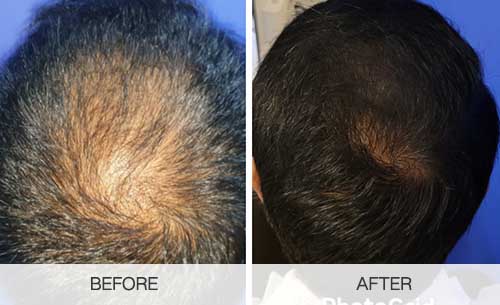before and after crown hair transplant