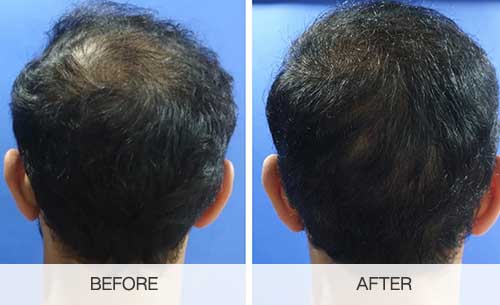 before and after crown hair transplant