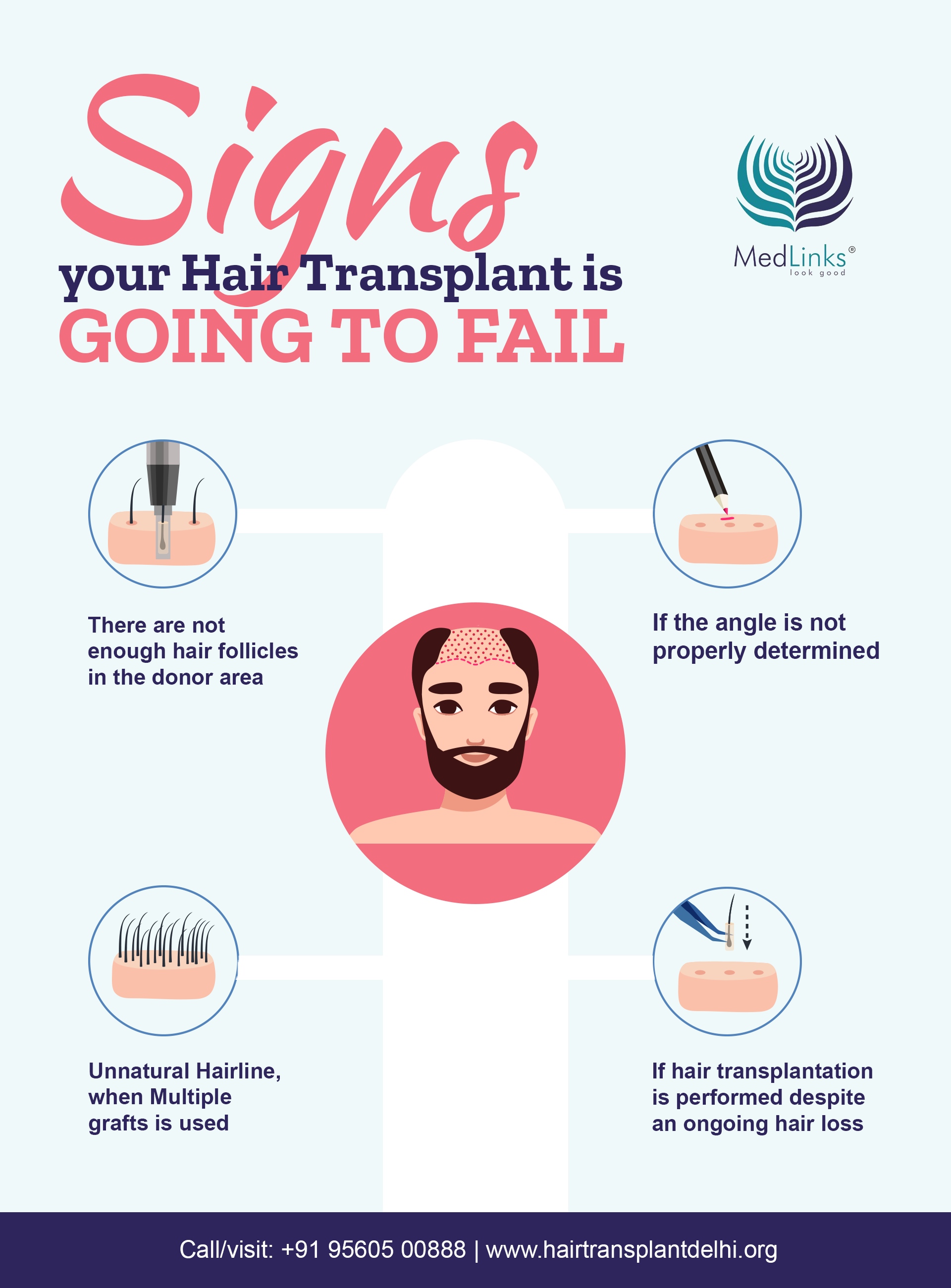 Botched Hair Transplant Fixed by Avrupa Hair Transplant  Clinicadvisor