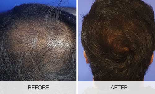 Hair Transplant Journey Hair Transplant After 3 Months  Results