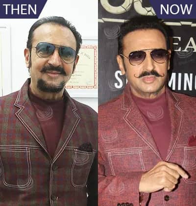 MedLinks Hair Transplant Results - Before and After medlinks-hair-transplant-in-delhi